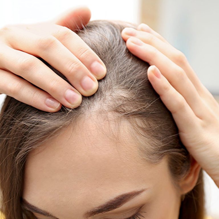 زراعة شعر مقدمة الرأس للنساء