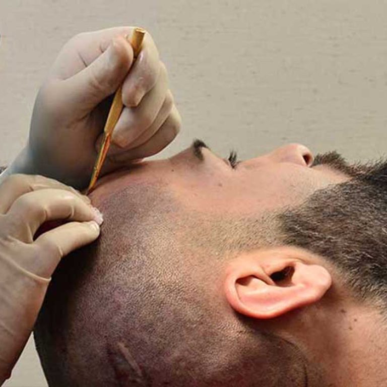 زرع الشعر بدون جراحة