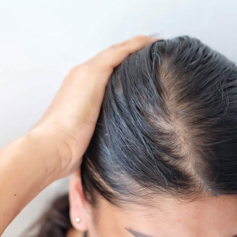 زرع شعر للنساء