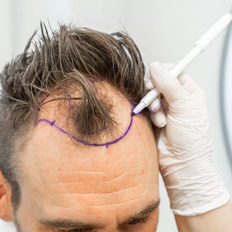 سعر زراعة الشعر