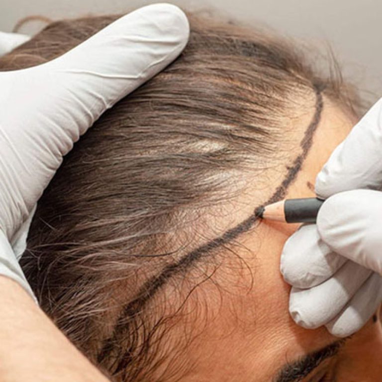سعر زراعة الشعر في الجبهة