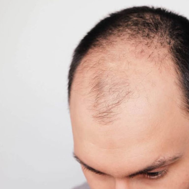 سعر عمليات زرع الشعر