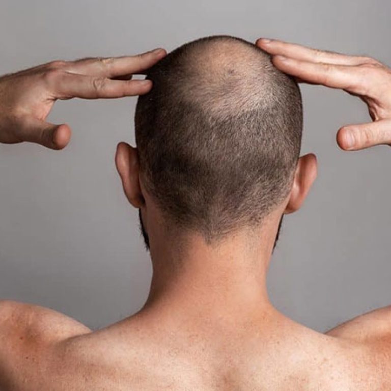 سعر عملية زراعة الشعر
