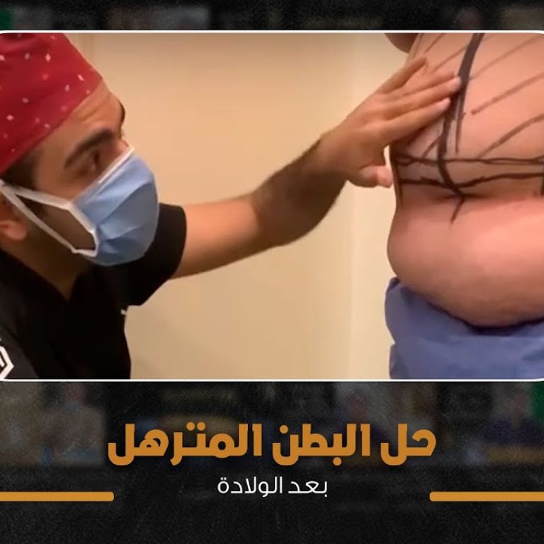 شد الجسم بعد علاج السمنة