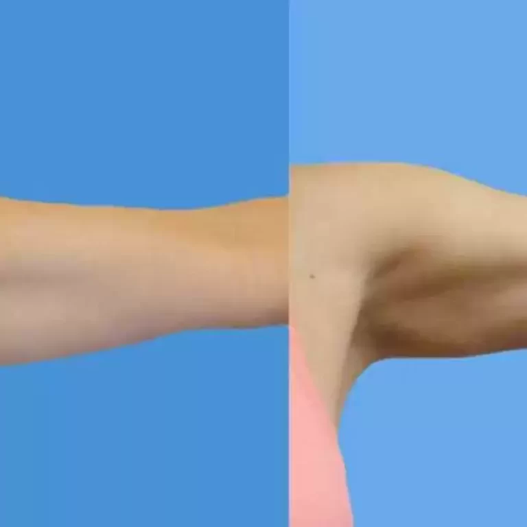 شفط دهون الزنود