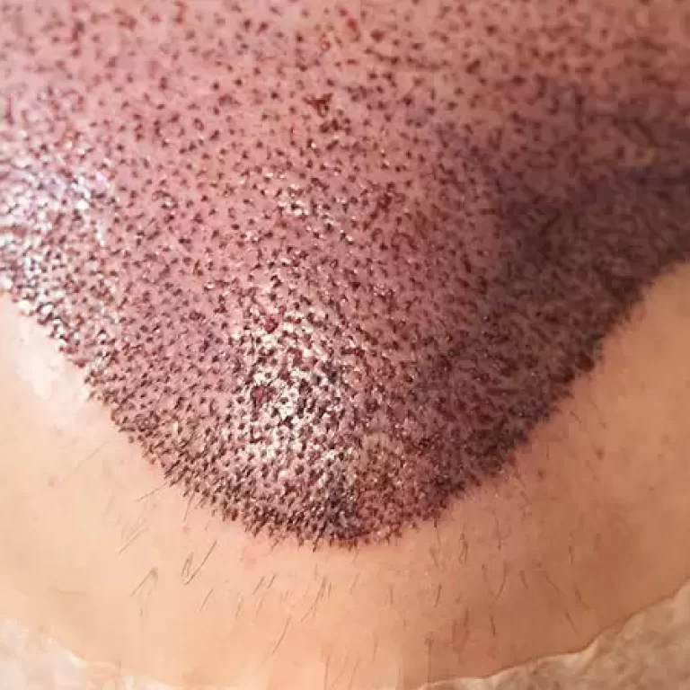 شكل الرأس بعد زراعة الشعر