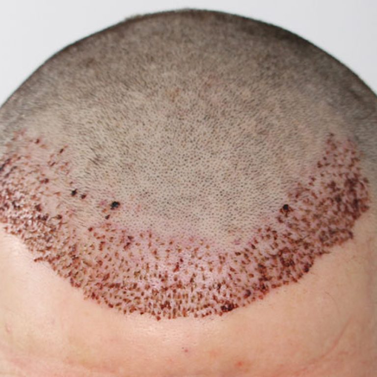 شكل الرأس بعد عملية زراعة الشعر