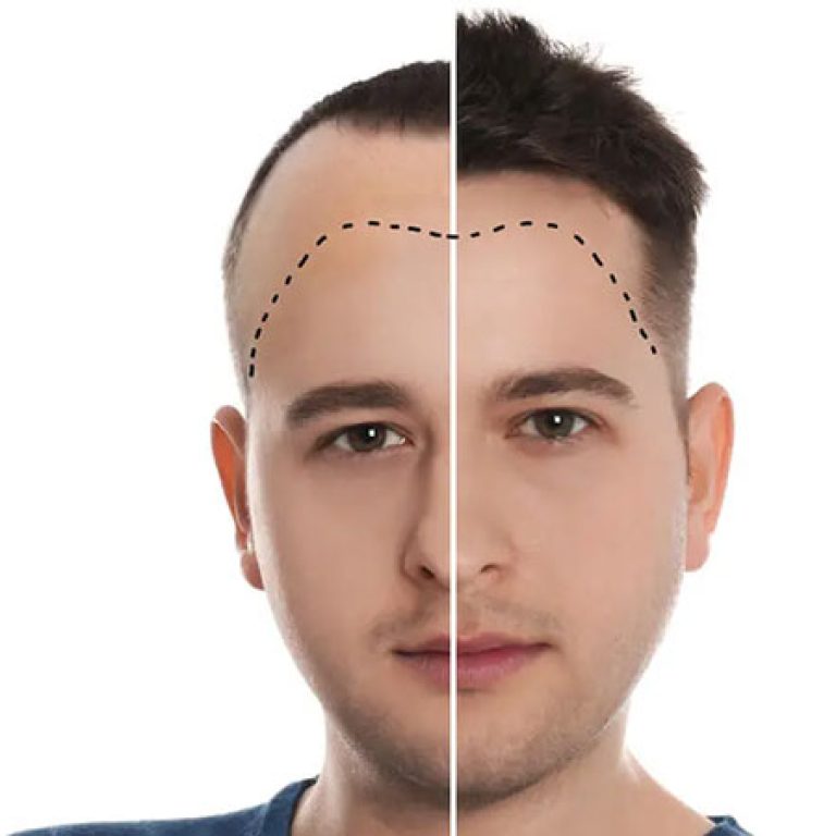 شكل زراعة الشعر