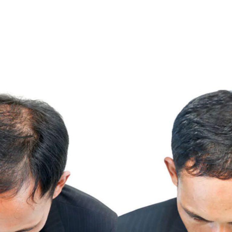 صور زراعة الشعر