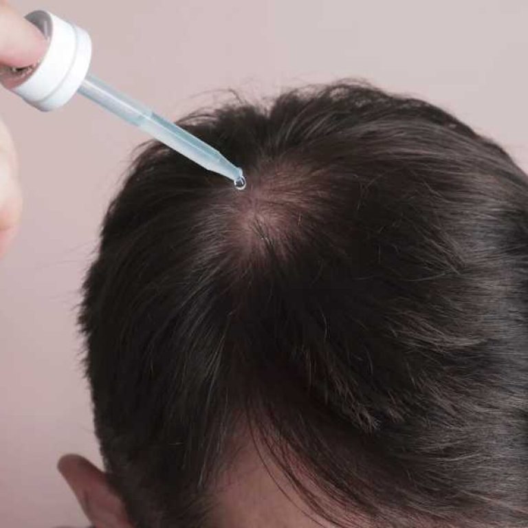 طريقة استخدام مينوكسيديل