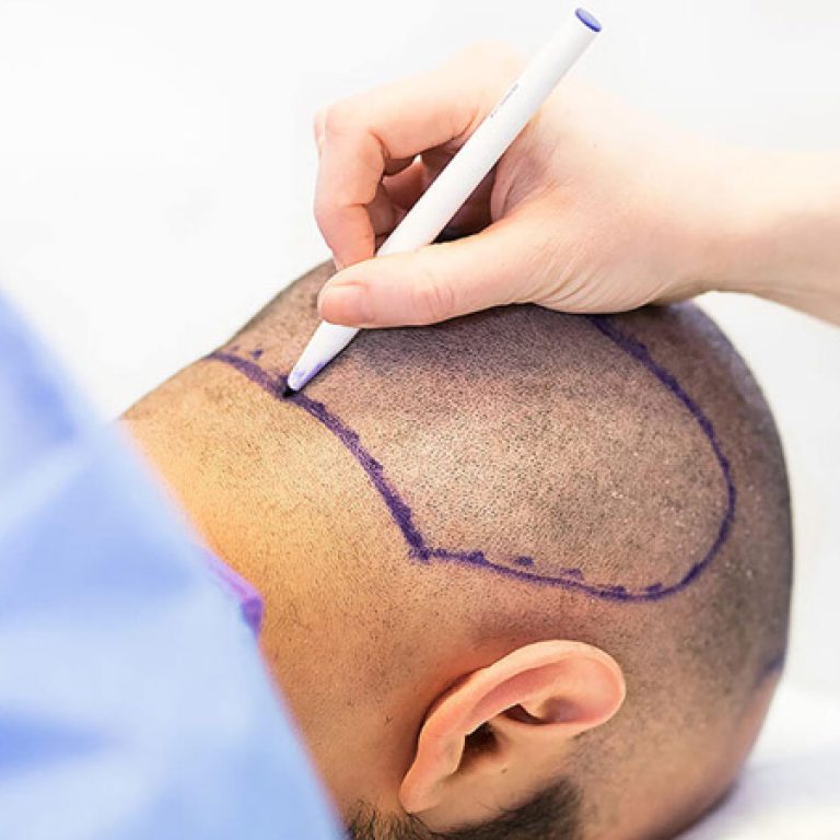 طريقة زراعة الشعر