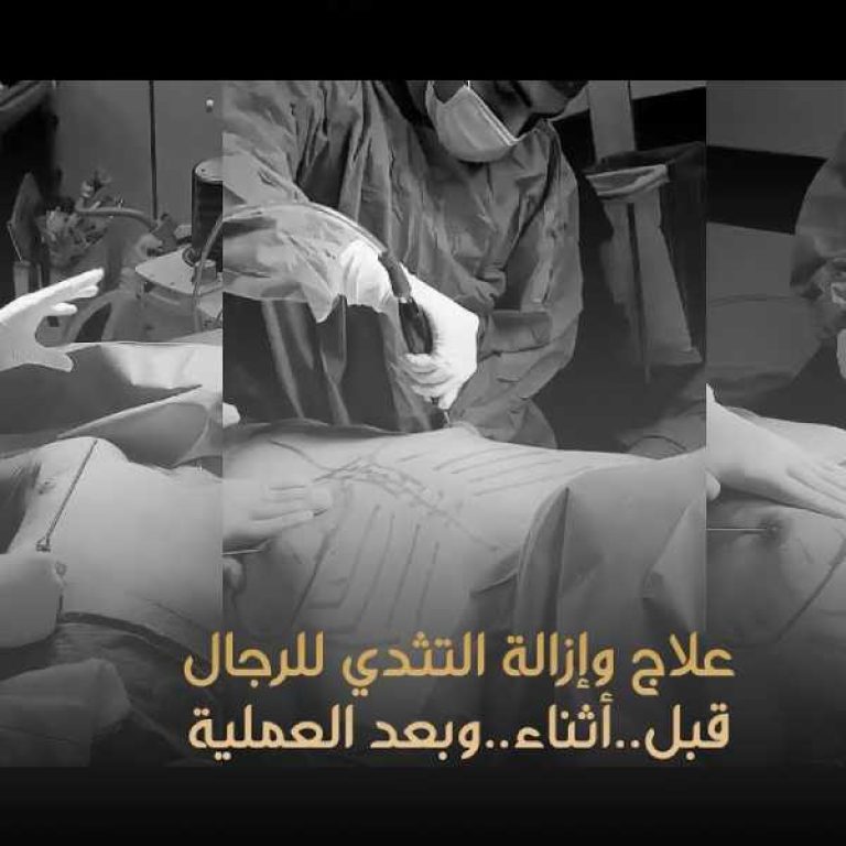 علاج التثدى للرجال