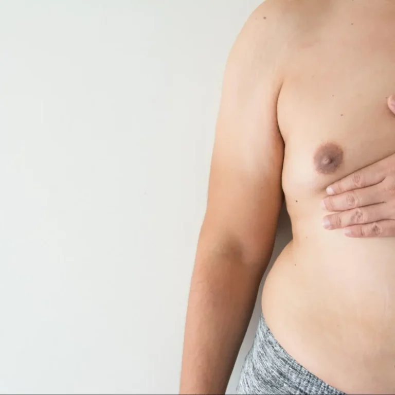 علاج التثدي عند المراهقين