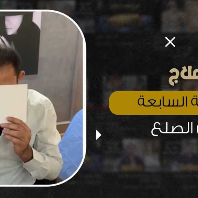 علاج الصلع الوراثي 2021