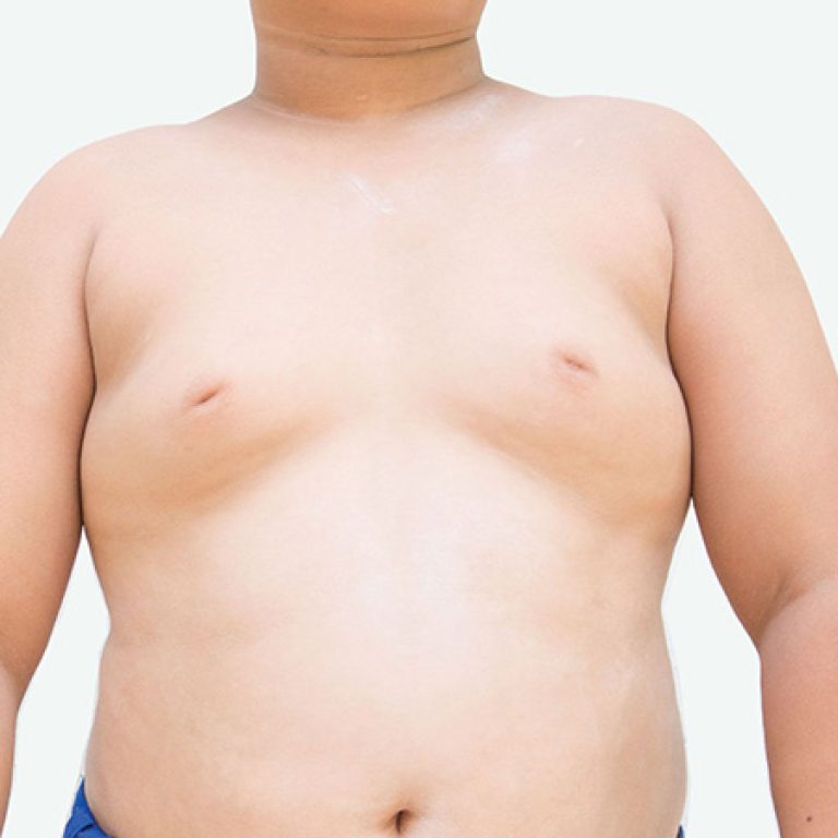 علاج تصغير الثدي عند الرجال بالاعشاب