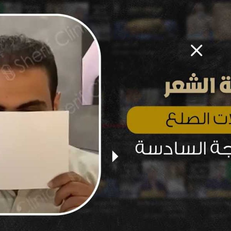 علاج صلع الشعر