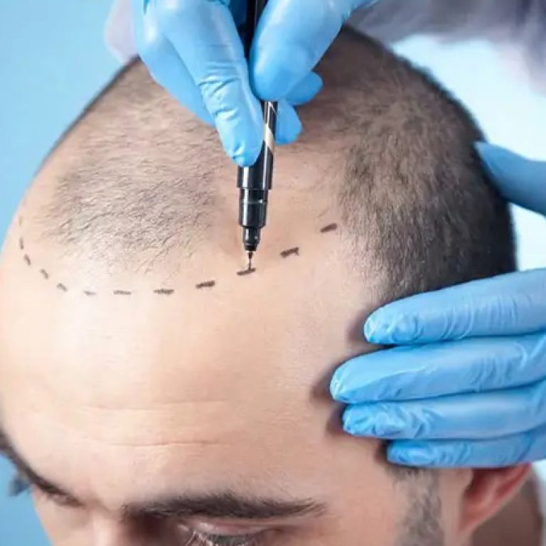 عمليات زراعة الشعر