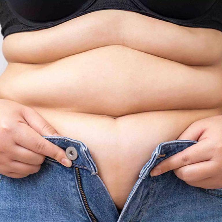 عمليات شفط البطن