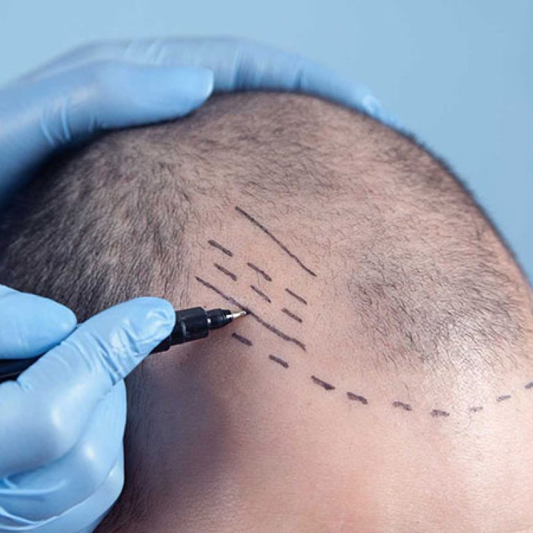 عملية زراعة الشعر