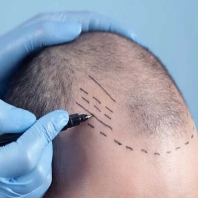 عملية زراعة الشعر بالاقتطاف