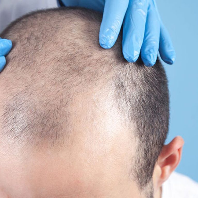 عملية زرع الشعر