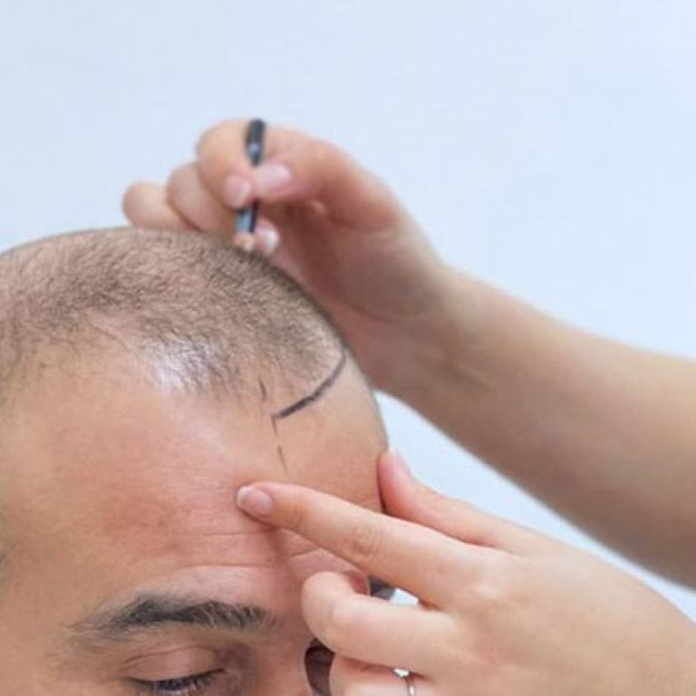 عيادة زراعة الشعر
