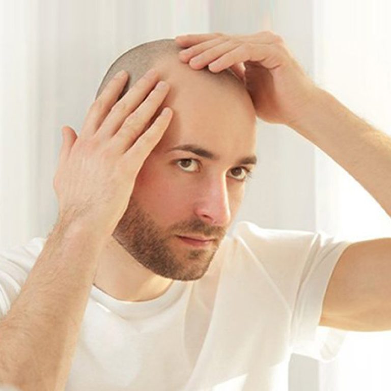 عيوب زراعة الشعر