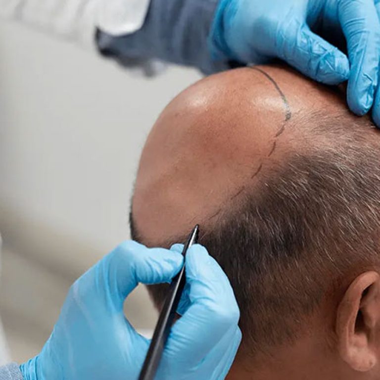 فوائد زراعة الشعر