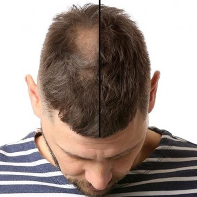 قبل وبعد زراعة الشعر الطبيعي