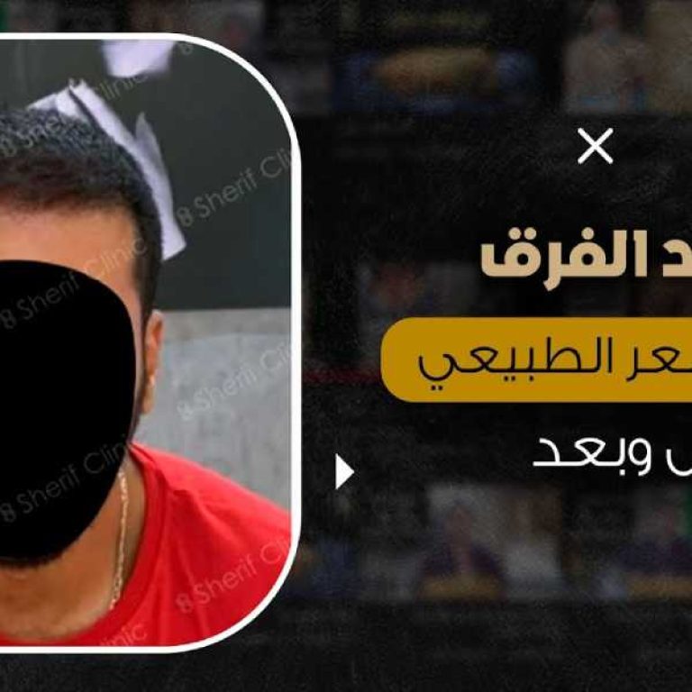 قبل وبعد زراعة الشعر