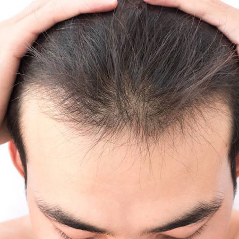 كم تكلفة زراعة الشعر