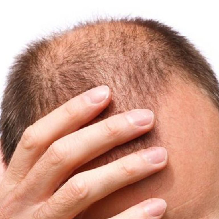 كم سعر زراعة الشعر