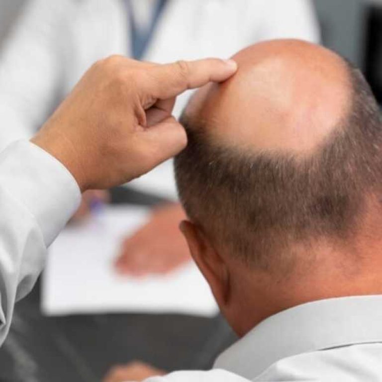 كيفية تحديد تكلفة زراعة الشعر