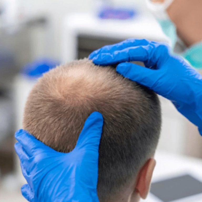 كيفية زراعة الشعر