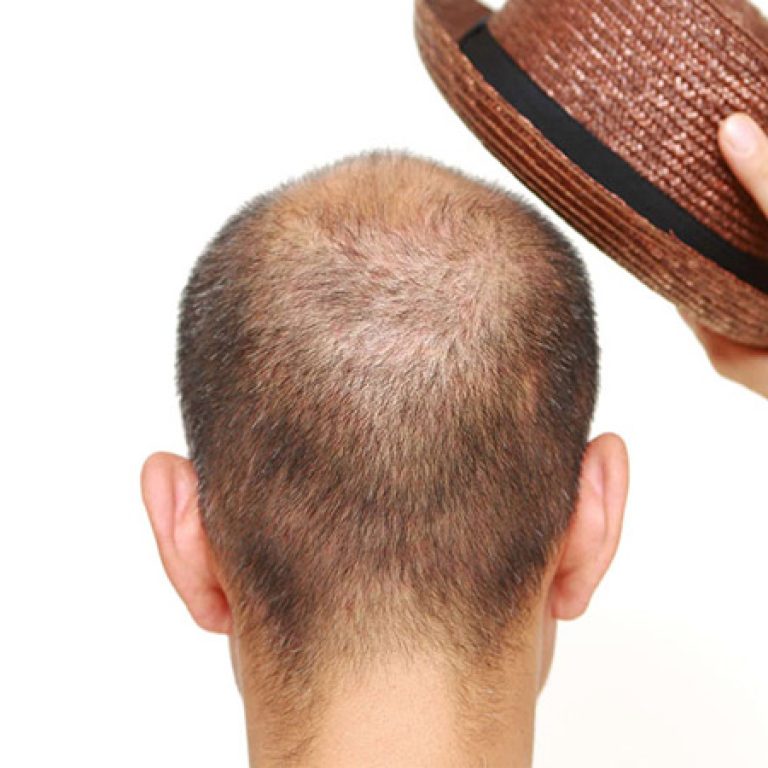 لبس القبعة بعد زراعة الشعر
