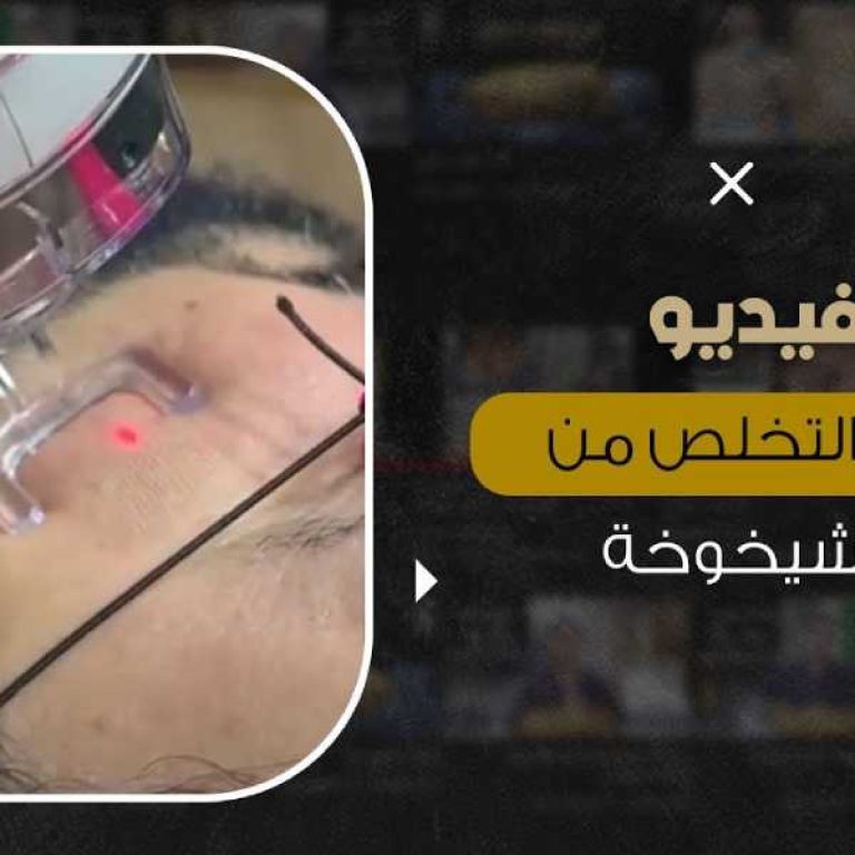 ليزر فراكشنال