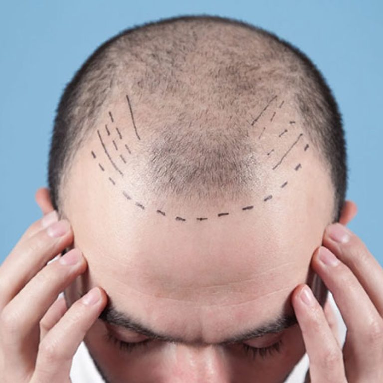 مخاطر زراعة الشعر