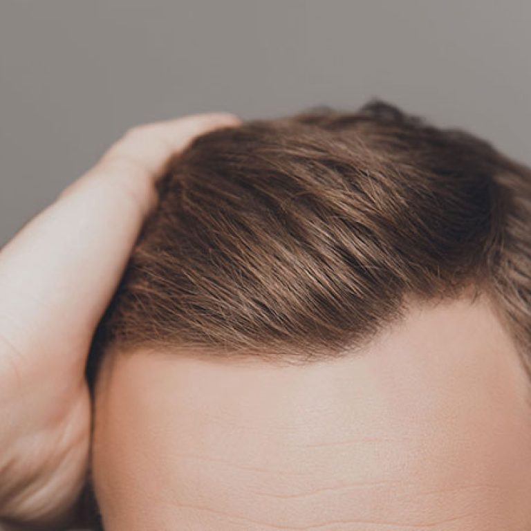 مدة عملية زراعة الشعر