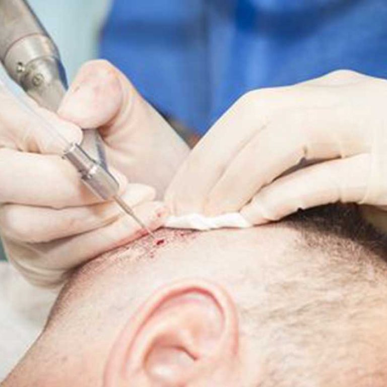 مراحل زراعة الشعر