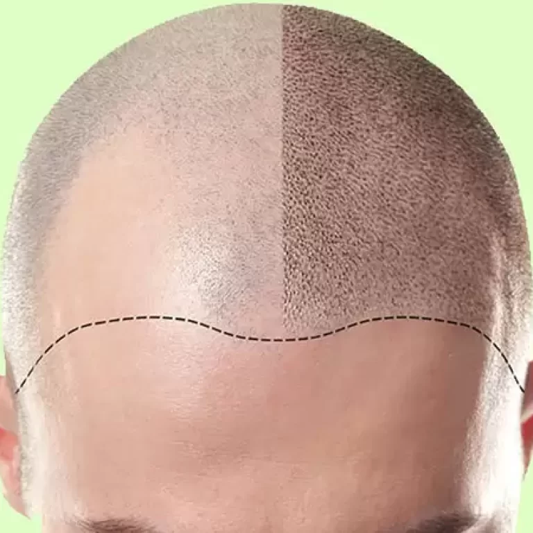 مراحل زراعة الشعر