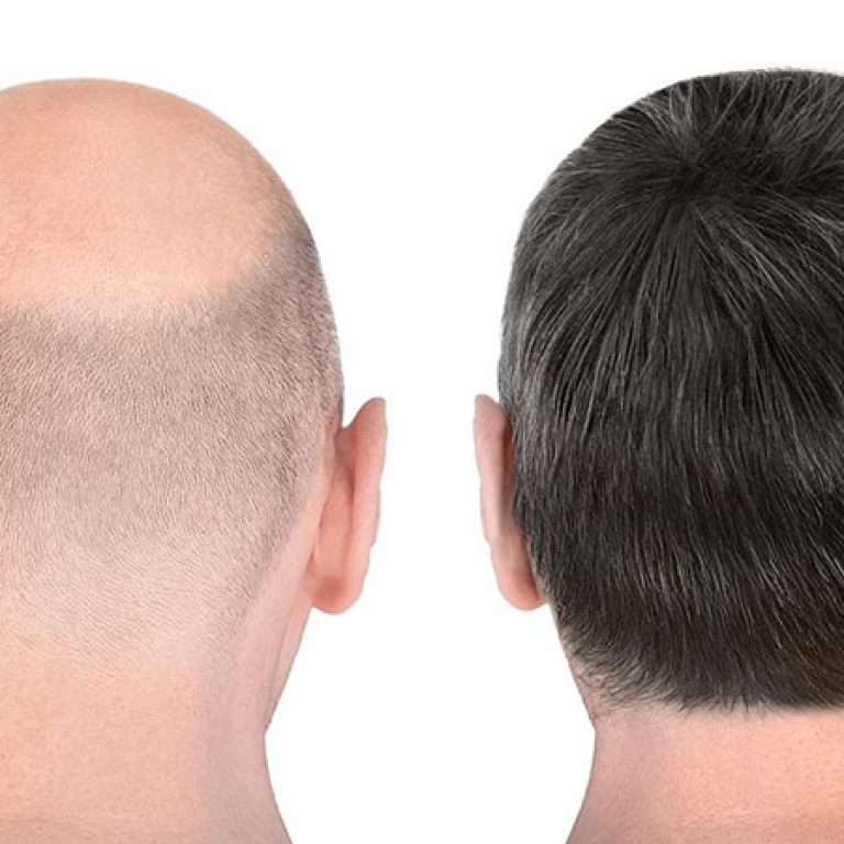 مراحل زرع الشعر