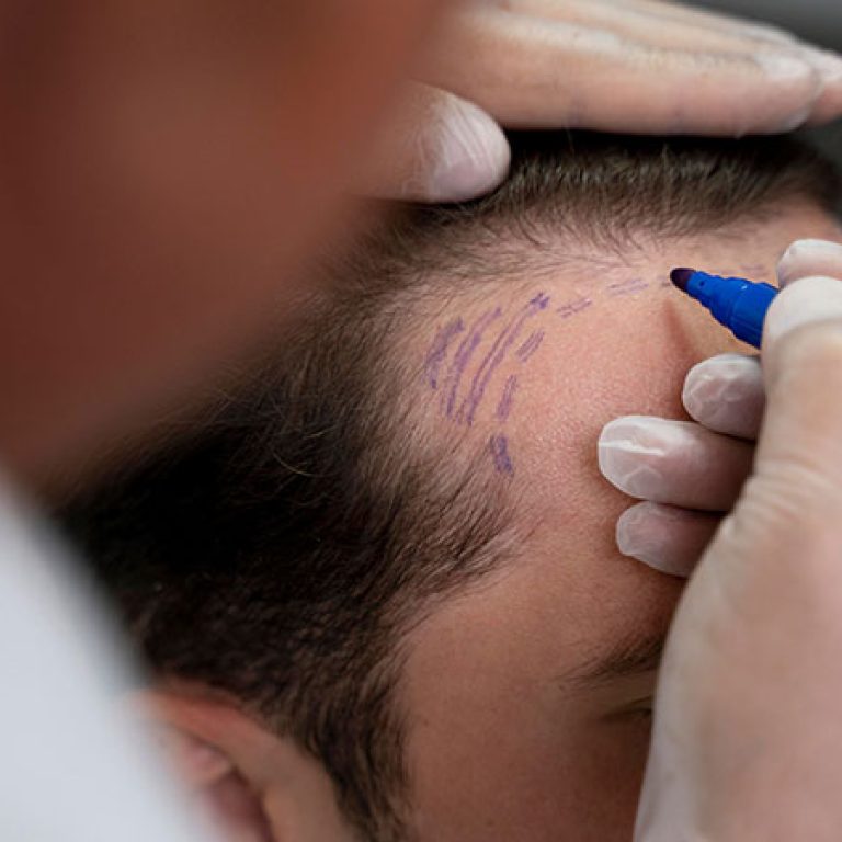مراكز زراعة الشعر