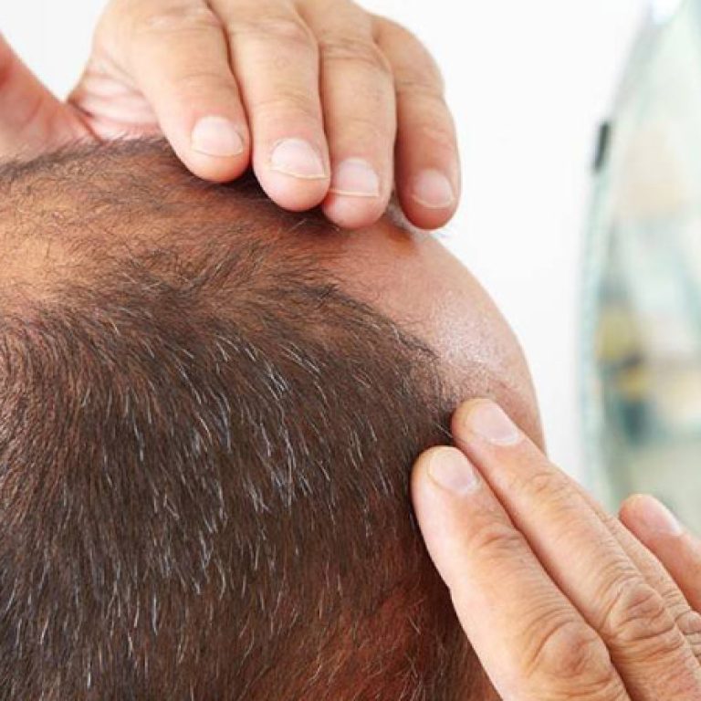 مركز زراعة الشعر