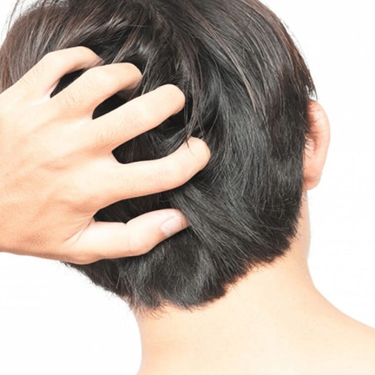 مشاكل زراعة الشعر