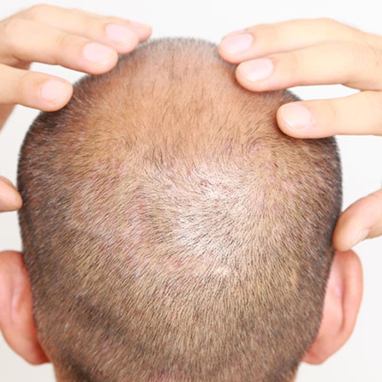 مضاعفات زراعة الشعر