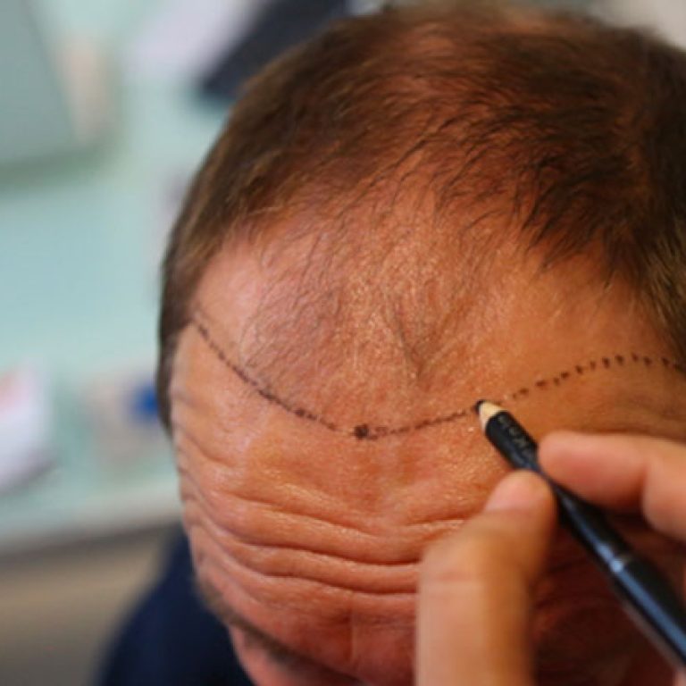 مين جرب زراعة الشعر في مصر