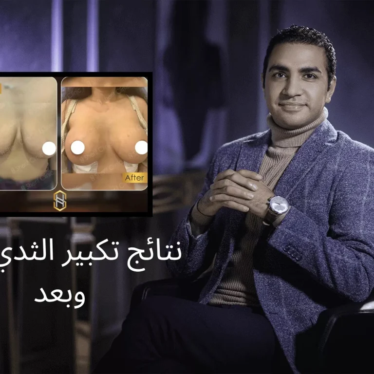 نتائج تكبير الثدي قبل وبعد