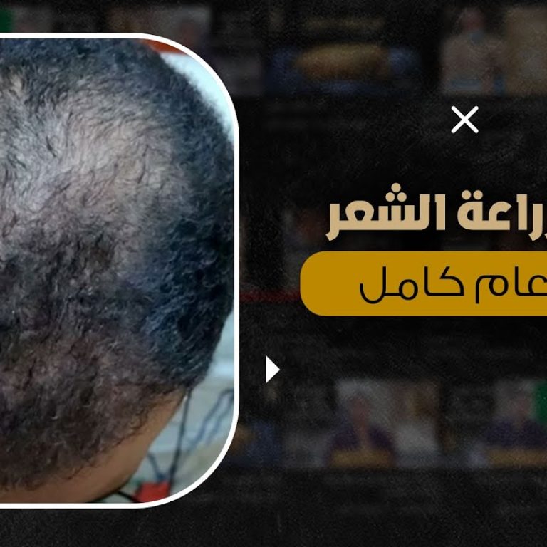 نتائج زراعة الشعر الطبيعي بتقنية الـ Nano-FUE
