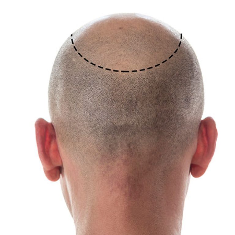 نتائج زراعة الشعر بالصور