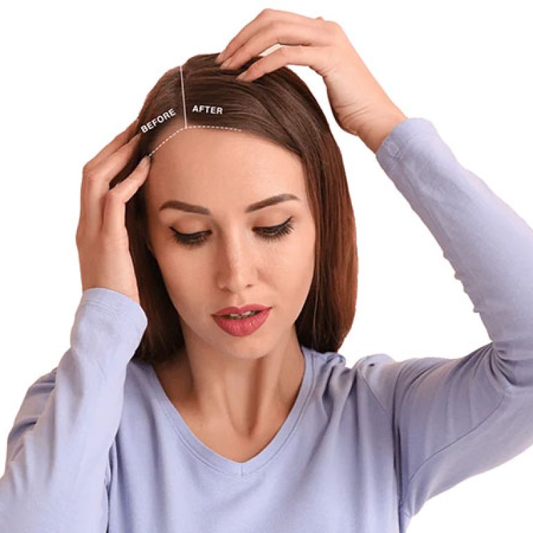 نتائج زراعة الشعر للنساء